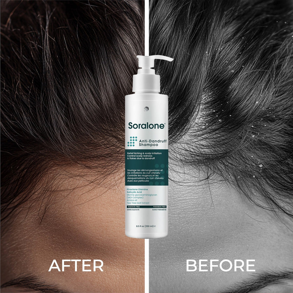 Soralone Anti-Dandruff Shampoo for itchy scalp