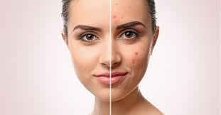 Oily and acne-prone skin control bundle products